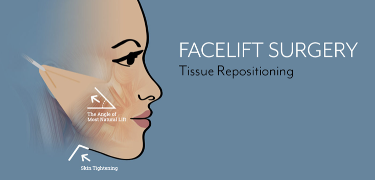 What to Expect from Facelift Surgery