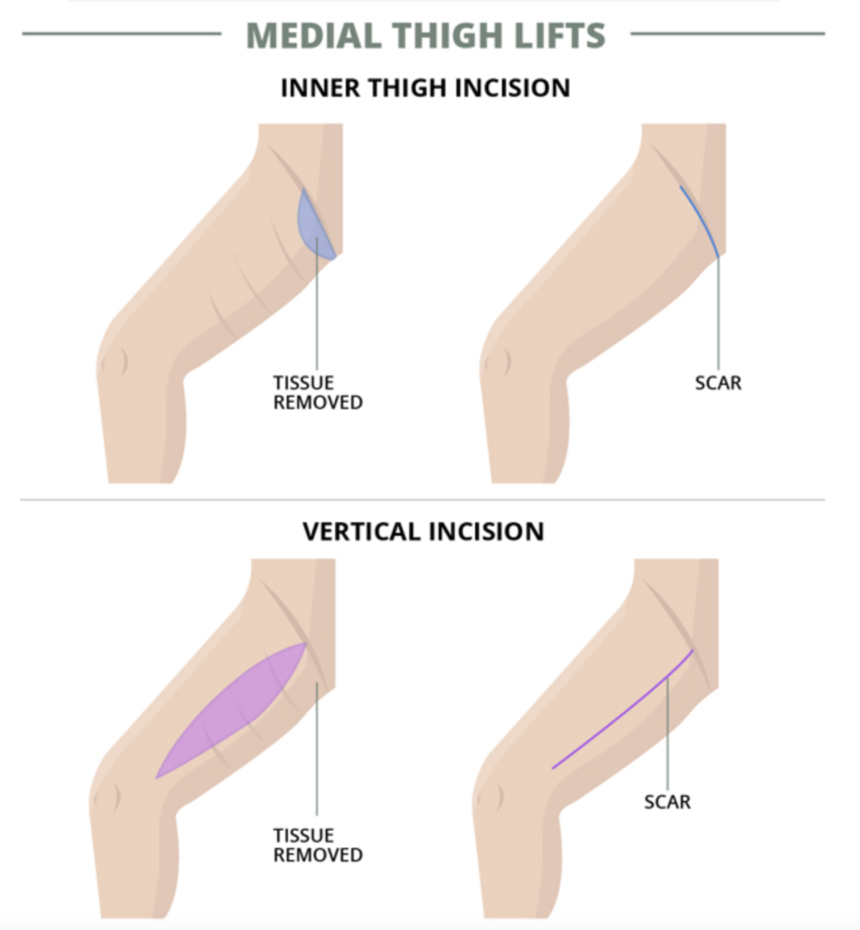 Thigh Lift Surgery Types