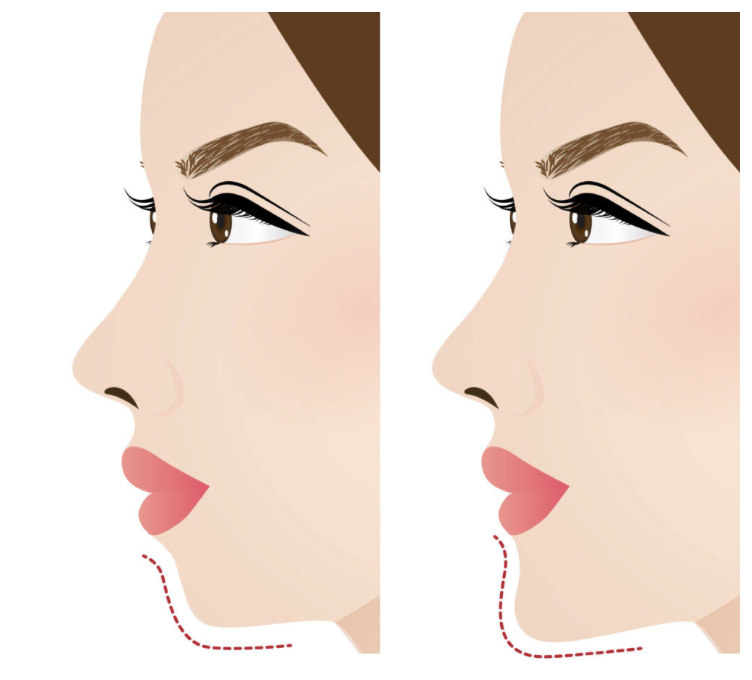 Benefits of Facial Implants