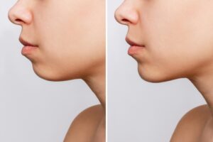 Before and After Chin Implant