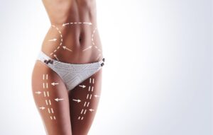 How Long to See Results From Liposuction