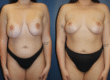 Breast Lift with Implant Estetica