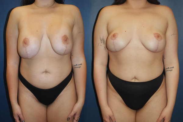 Breast Lift with Implant Estetica