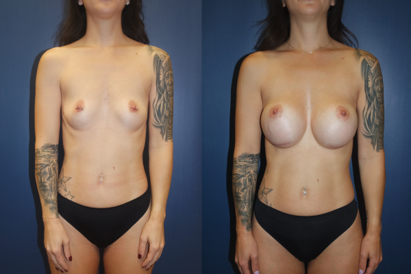 Estetica Breast Lift With Implant