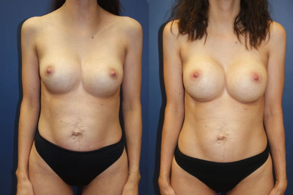 Breast Implant Estetica